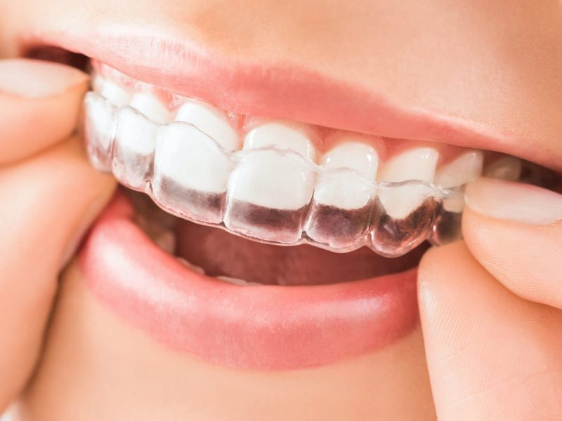 alinhadores-invisiveis-01