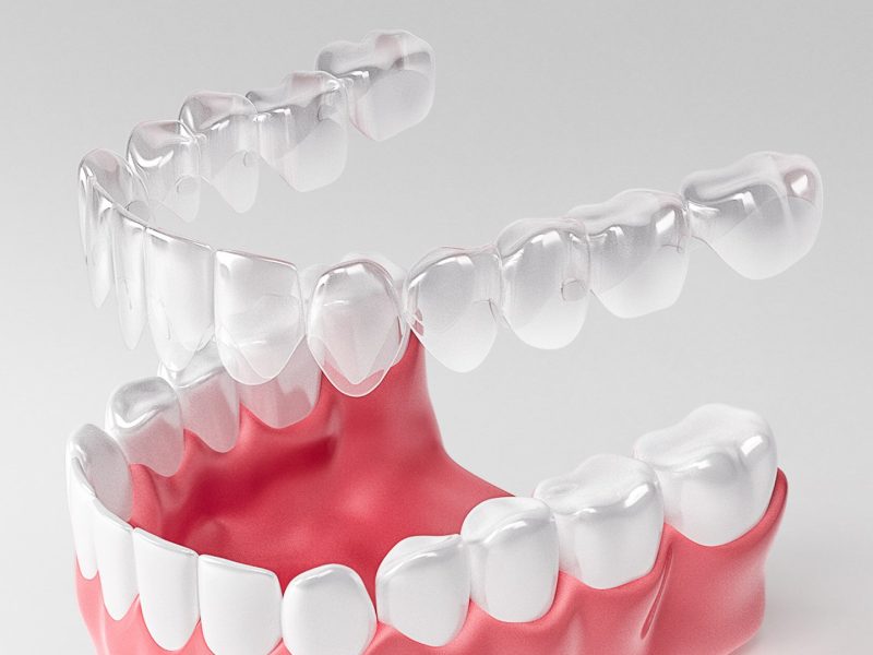 alinhadores-invisiveis-02