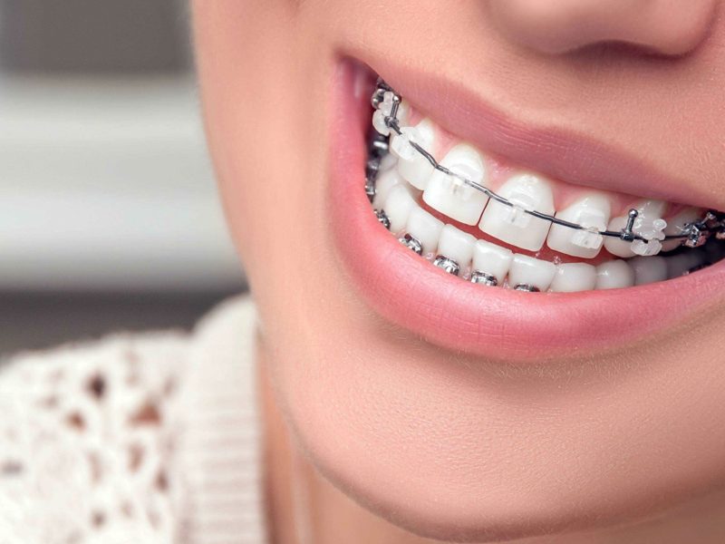 aparelho-ortodontico-01