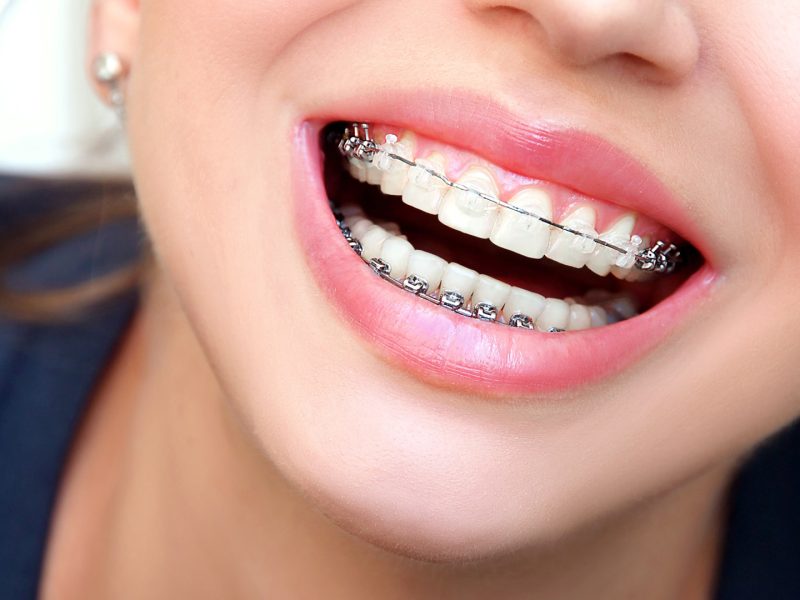 aparelho-ortodontico-02