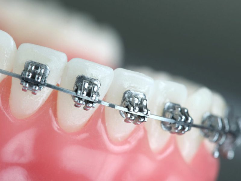 aparelho-ortodontico-06