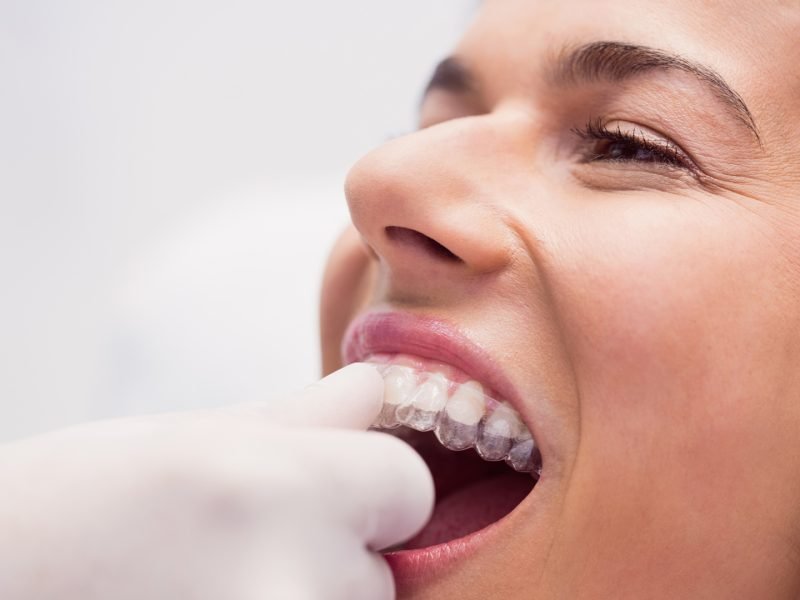 clareamento-dental-02