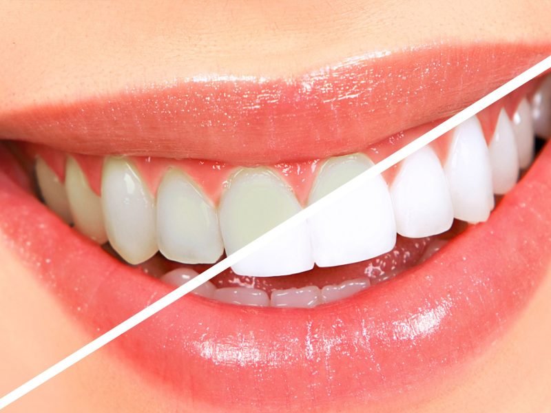 clareamento-dental-04