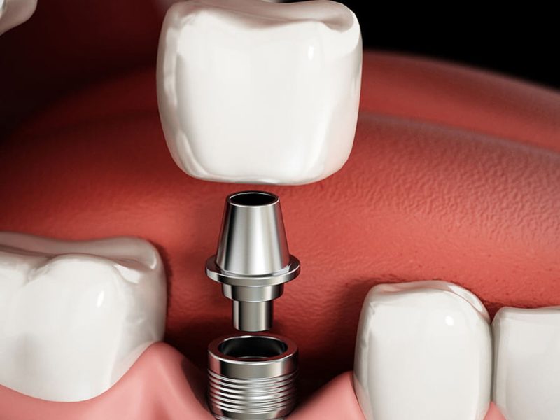 implante-dentário-01