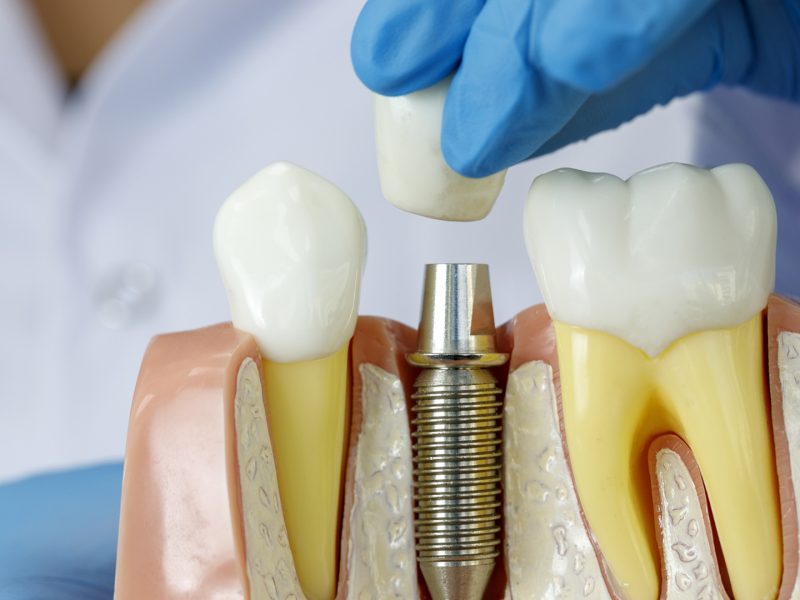 implante-dentário-02