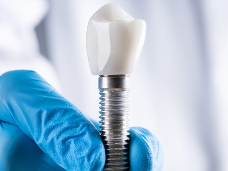implante-dentário-03