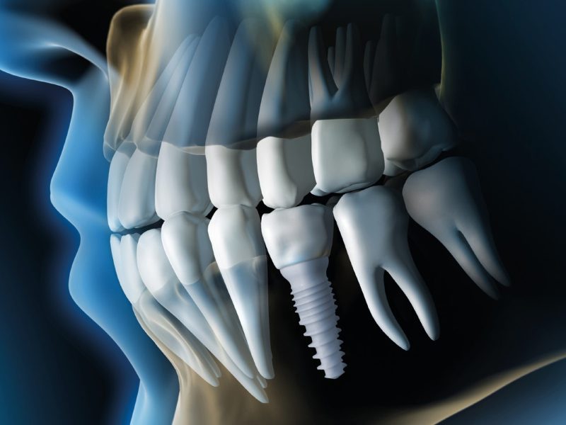 implante-dentário-05