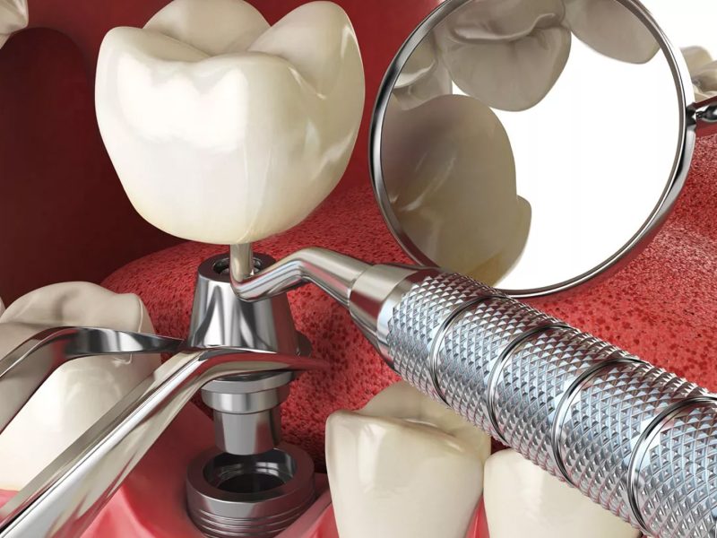 implante-dentário-06