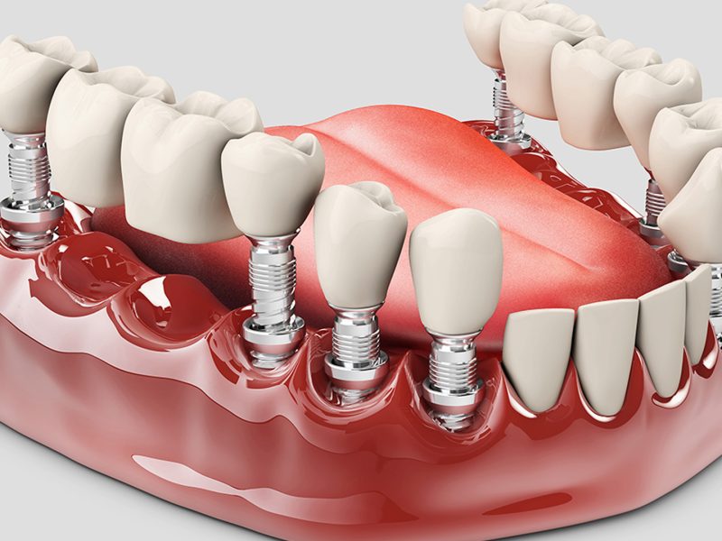 prótese-dentaria-04