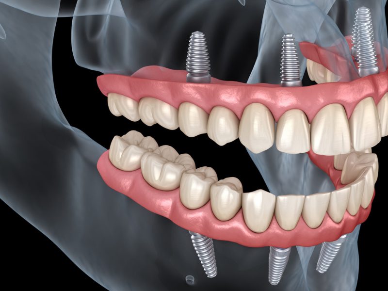 protese-protocolo-04
