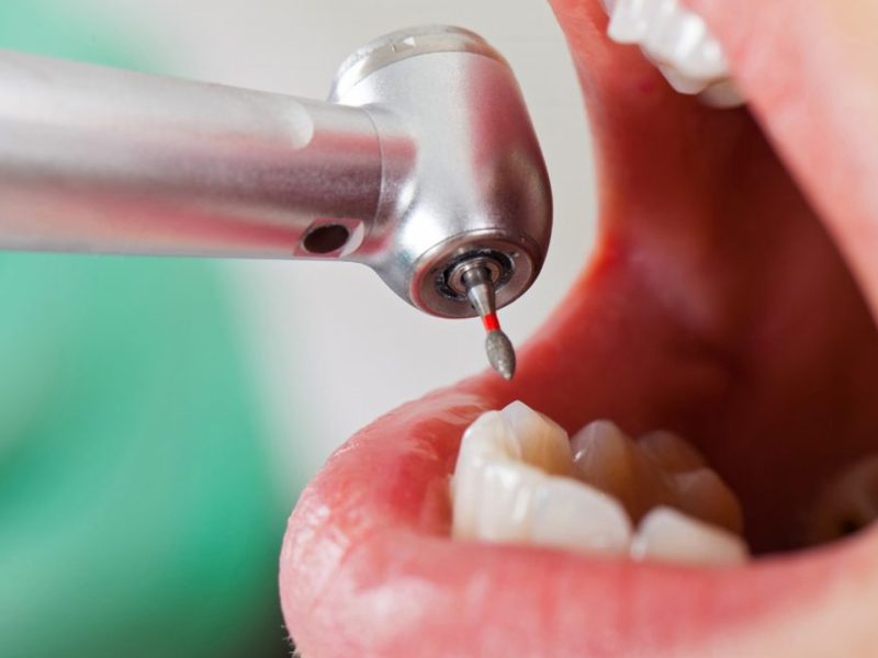 restauracao-dentaria-01