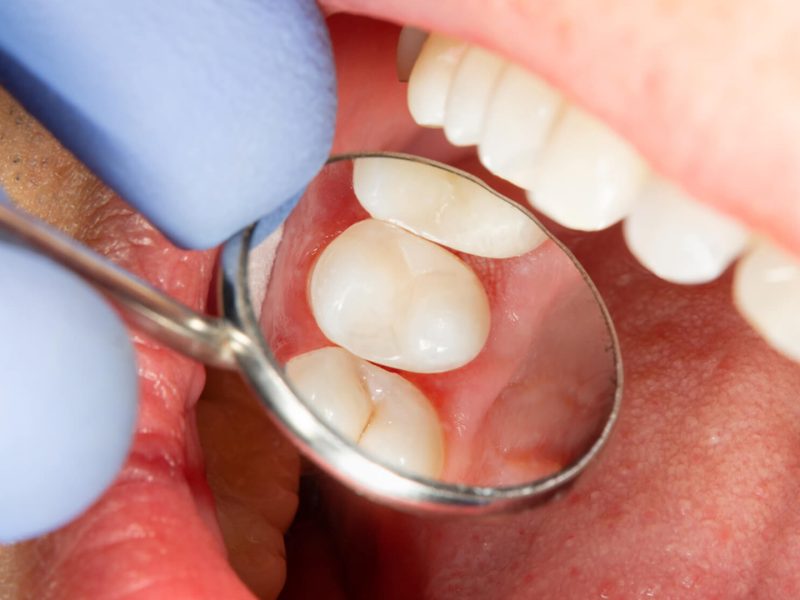 restauracao-dentaria-02