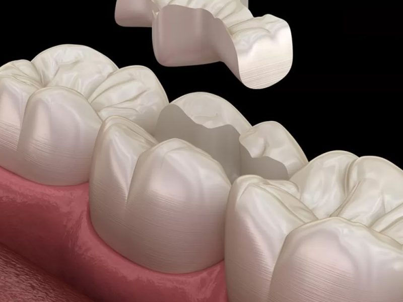 restauracao-dentaria-03